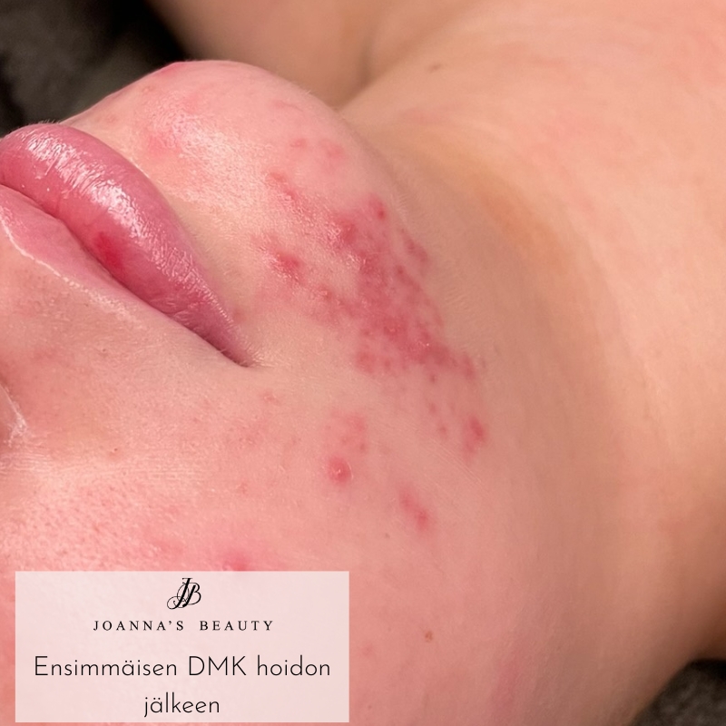 DMK-entsyymiterapia 4